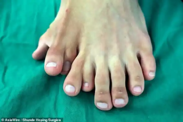 Chinese man born with nine toes undergoes surgery to cut off four of them